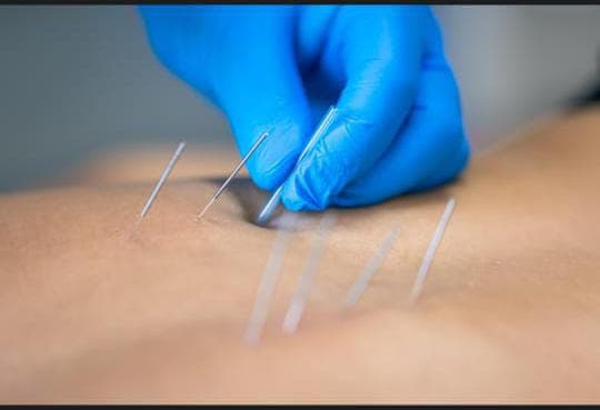 Dry Needling in Bellandur – Targeted Relief for Muscle Knots & Chronic Pain